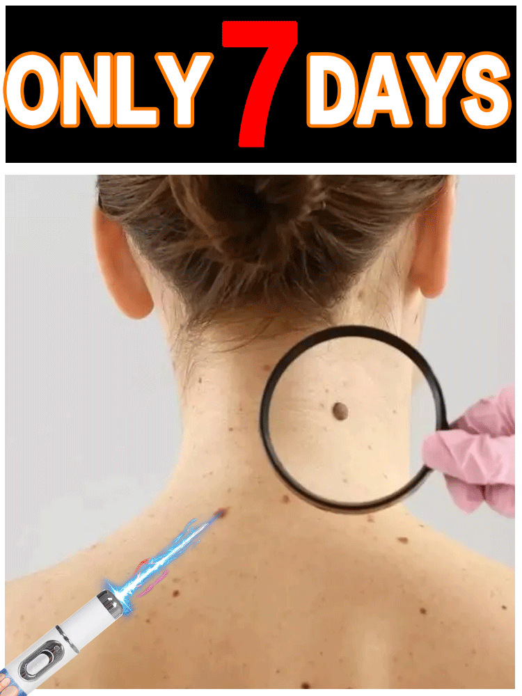 Combo Power Tools - Powerful blue pen wart removal tool,